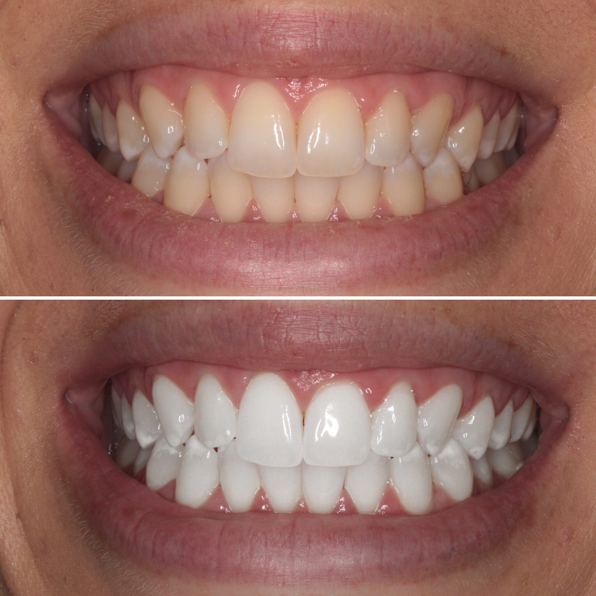отбеливание зубов до и после фото