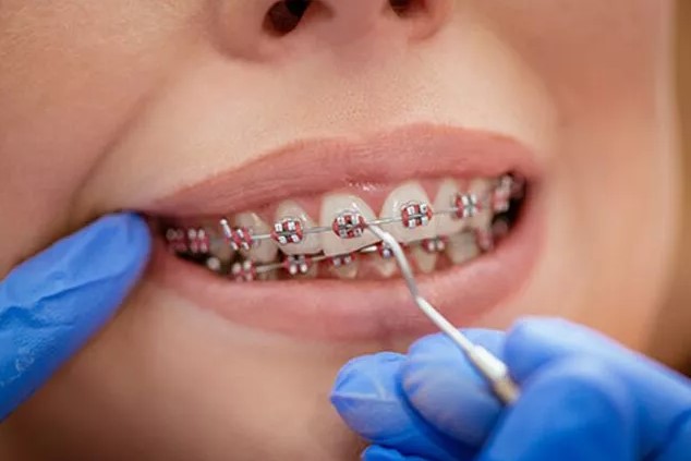 брекеты на зубы металлические фото